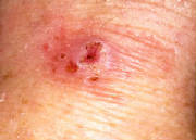 The wart scabbed over.jpg