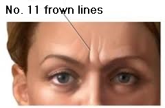 They are known as No. 11 frown lines.jpg
