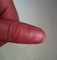 wart on finger gone.JPG