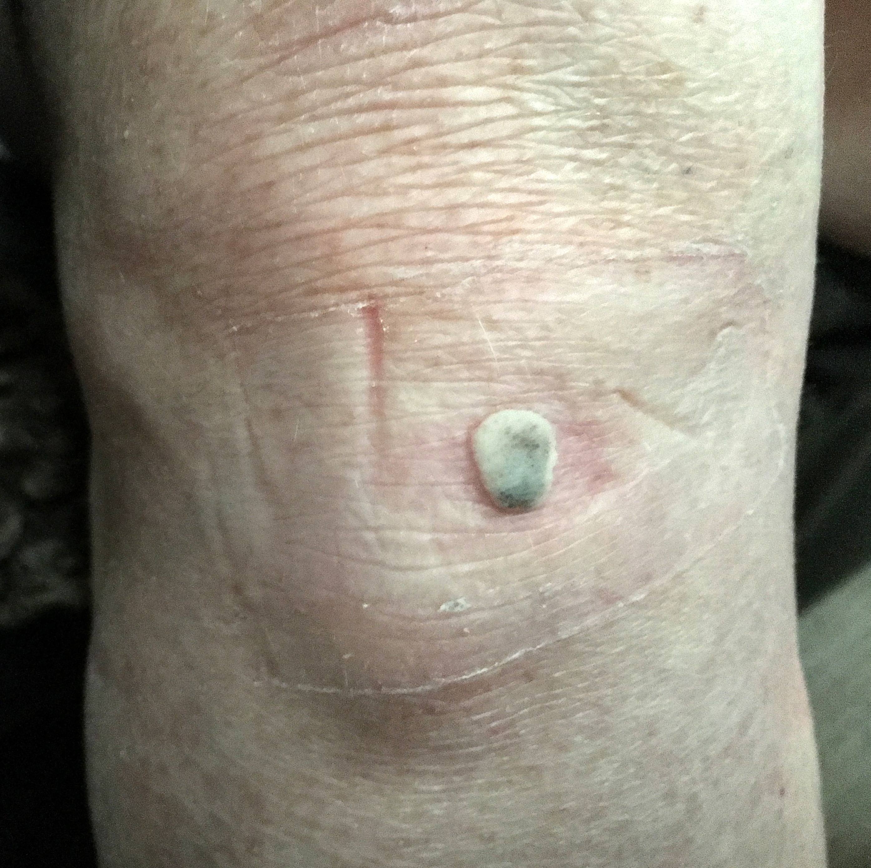 the wart on my knee was getting bigger.JPG